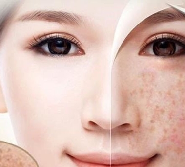 Giải Pháp Điều Trị Tàn Nhang Đồng Xoài Tận Gốc Không Tái Phát – Bí Quyết Da Đẹp Tự Nhiên Từ Spa Như Ý