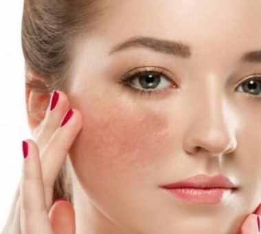 Tìm Hiểu Phương Pháp Điều Trị Nám Đồng Xoài An Toàn Và Hiệu Quả Tại Spa Như Ý