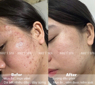 Điều Trị Mụn Lưng Đồng Xoài Hiệu Quả Chuẩn Y Khoa Tại Spa Như Ý