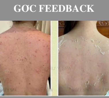 Chuyên trị mụn lưng tại Spa Như Ý Đồng Xoài – Sạch mụn, sáng da, tự tin tỏa sáng