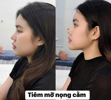 Tiêm Tan Mỡ Nọng Cằm Hiệu Quả Tại Spa Như Ý – Spa Đồng Xoài Uy Tín Giúp Thon Gọn Gương Mặt