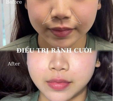 Xóa Rãnh Cười Không Phẫu Thuật Tại Spa Như Ý – Spa Đồng Xoài Uy Tín, An Toàn