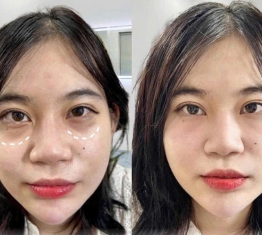 Meso Trị Thâm Mắt Hiệu Quả Không Cần Phẫu Thuật | Spa Đồng Xoài – Spa Như Ý