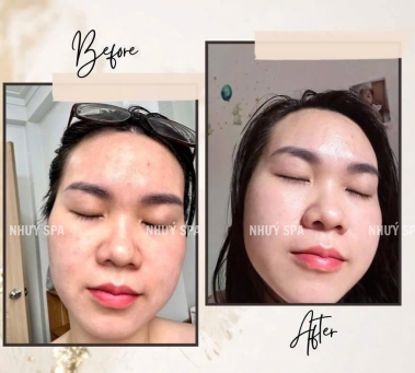 Meso Trắng Da Căng Bóng Chuẩn Y Khoa Tại Spa Như Ý – Spa Đồng Xoài Uy Tín