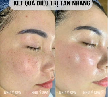 Điều Trị Tàn Nhang Đồng Xoài – Giải Pháp Làm Đẹp Tự Nhiên Từ Spa Như Ý