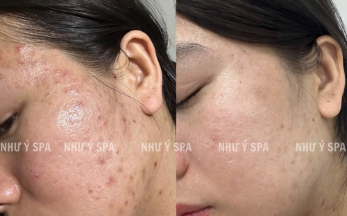 Spa Trị Mụn Đồng Xoài - Spa Như Ý: Địa Chỉ Uy Tín Chuẩn Y Khoa