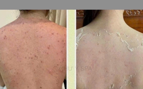 Chuyên trị mụn lưng tại Spa Như Ý Đồng Xoài – Sạch mụn, sáng da, tự tin tỏa sáng