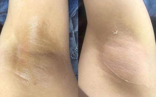 Peel thâm nách an toàn – Hiệu quả tại Spa Như Ý, spa Đồng Xoài uy tín hàng đầu