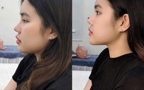 Tiêm Tan Mỡ Nọng Cằm Hiệu Quả Tại Spa Như Ý – Spa Đồng Xoài Uy Tín Giúp Thon Gọn Gương Mặt