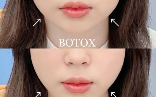 Tiêm Botox Thon Gọn Hàm Không Phẫu Thuật Tại Spa Đồng Xoài – Mặt V-line Chuẩn Hàn