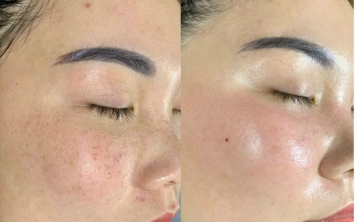 Điều Trị Tàn Nhang Đồng Xoài – Giải Pháp Làm Đẹp Tự Nhiên Từ Spa Như Ý