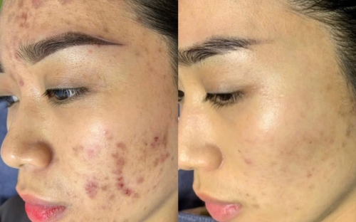 Trị Thâm Mụn Hiệu Quả – Lấy Lại Làn Da Sáng Mịn Tại Spa Như Ý | Spa Đồng Xoài Uy Tín