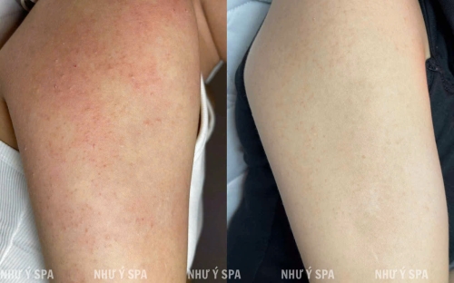 Điều Trị Viêm Nang Lông Hiệu Quả Tại Spa Đồng Xoài – Giải Pháp Cho Làn Da Mịn Màng, Khỏe Mạnh