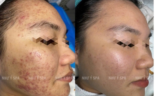 Điều Trị Mụn Hiệu Quả, An Toàn Tại Spa Như Ý – Spa Đồng Xoài Uy Tín Số 1