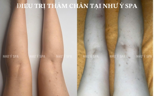 Điều Trị Thâm Chân An Toàn, Hiệu Quả Tại Spa Như Ý – Spa Đồng Xoài Uy Tín