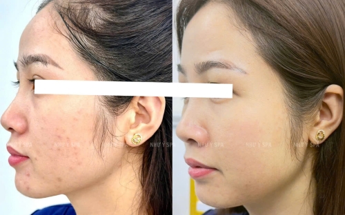 Peel Da Trị Mụn An Toàn – Hiệu Quả Tại Spa Như Ý | Spa Đồng Xoài Uy Tín